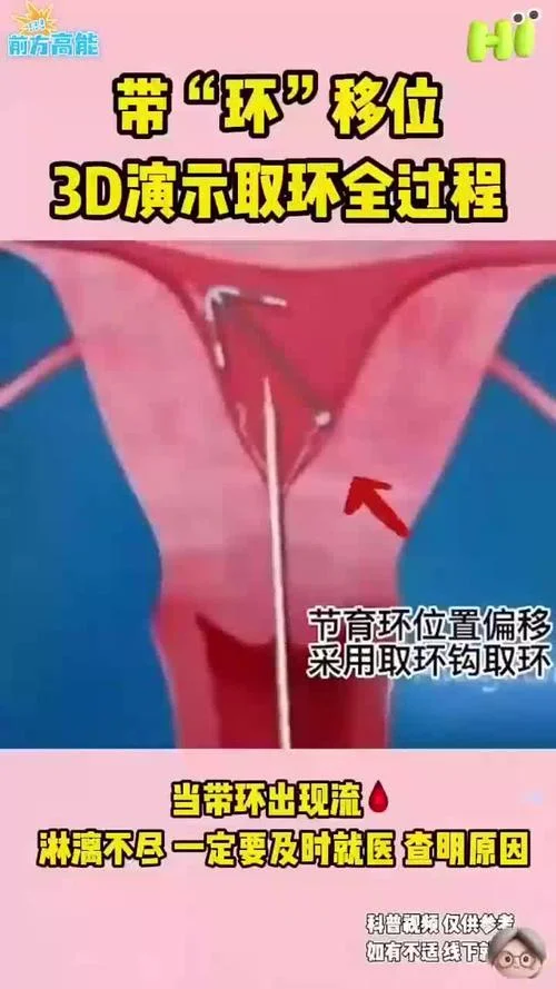 女人带环怀孕了怎么办-带环怀孕怎么办