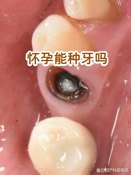 怀孕做梦牙蛀牙_1