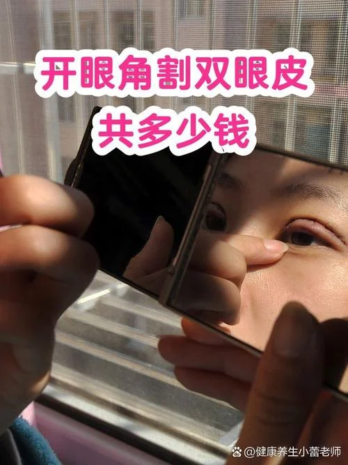 开外眼角大概要多少钱_2