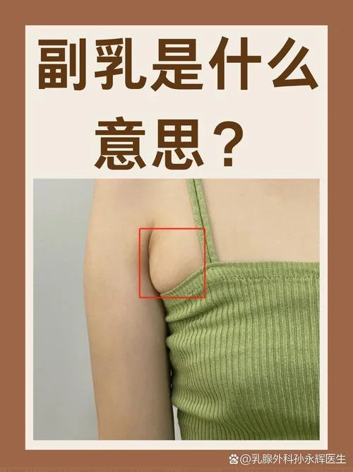 什么是副乳图片大全-副乳图片分类大全