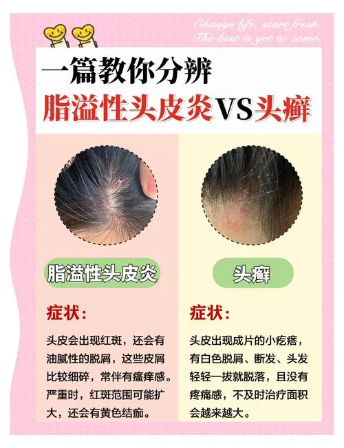 头上头皮屑成块怎么办_2