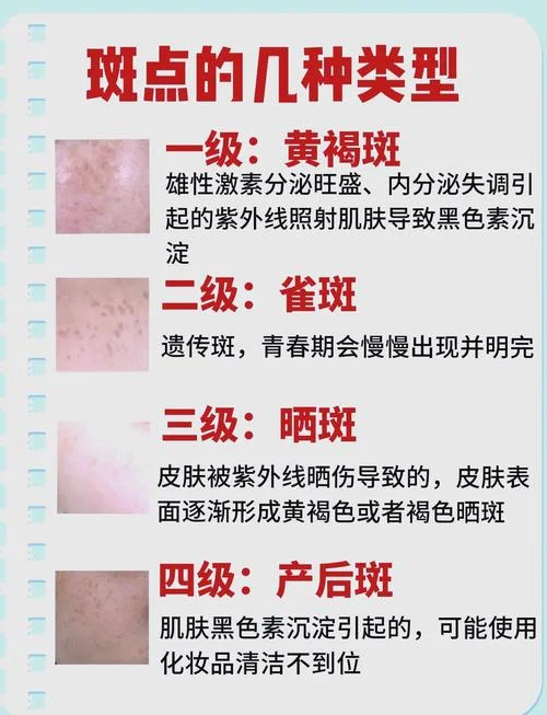 祛斑去掉需要多少钱_1