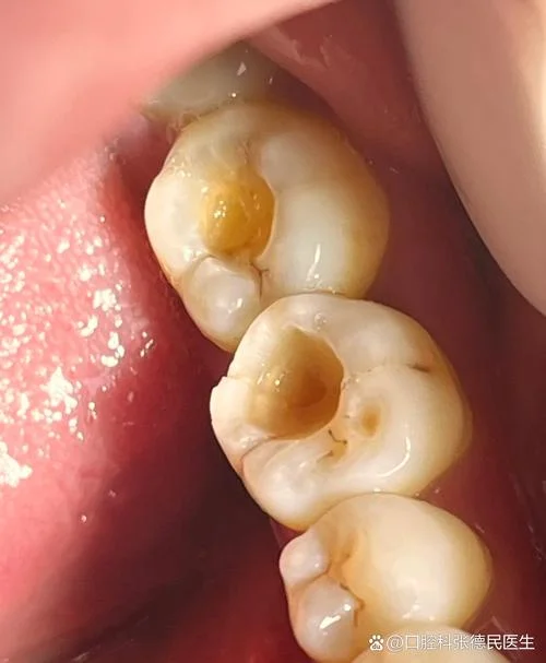 梦到牙洞_2