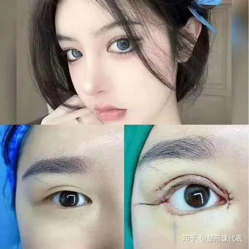 荆州割韩式双眼皮多少钱_1