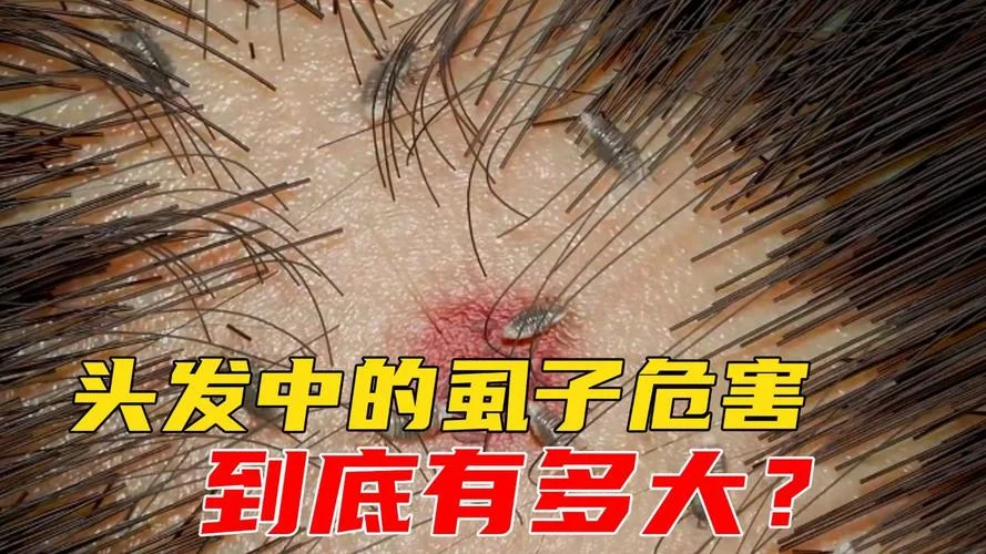 梦见自己头上好多虱子_1
