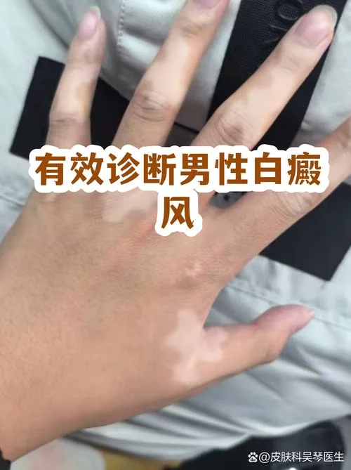 诊断白癜风多少钱_1