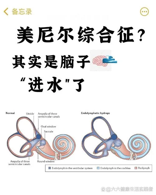 什么是美尼尔斯综合症-美尼尔斯综合征