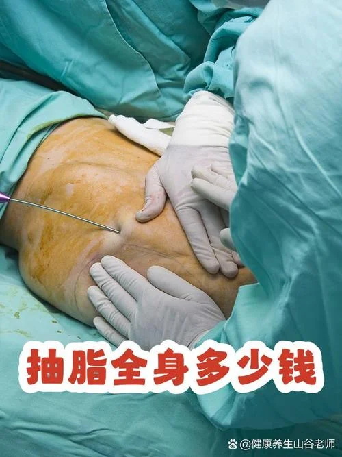 现在全身抽脂多少钱_2