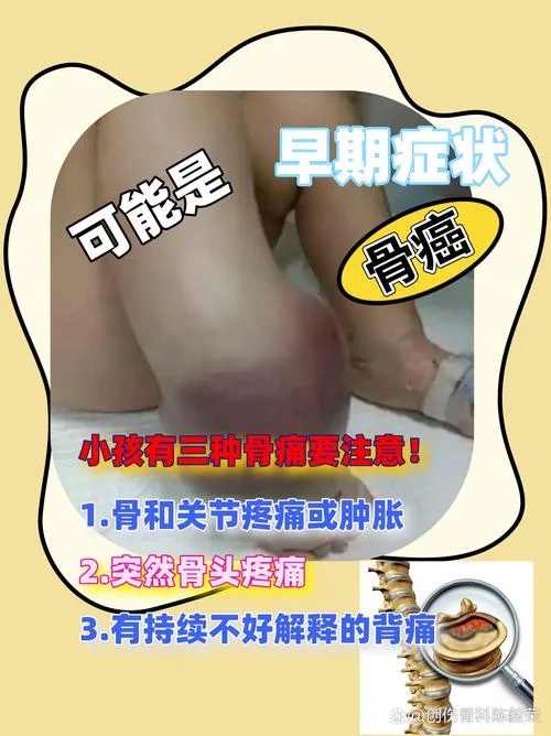 早期骨癌如何筛查_1