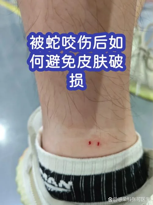 梦见蛇咬自己咬伤_1