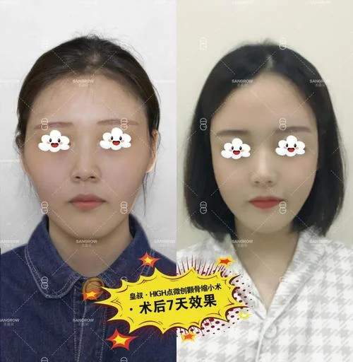 磨骨多少钱黄大勇_1