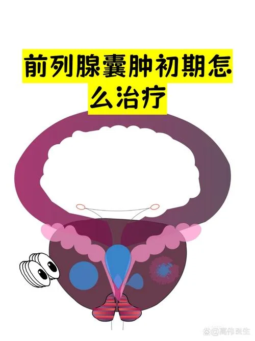 前列腺内囊肿什么意思-前列腺囊肿是什么意思