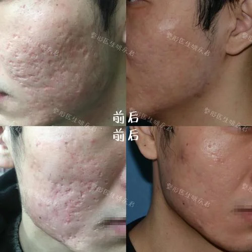 治疗痘坑要多少钱_1