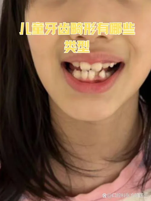 虎牙地包天面相好不好-虎牙地包天面相好坏