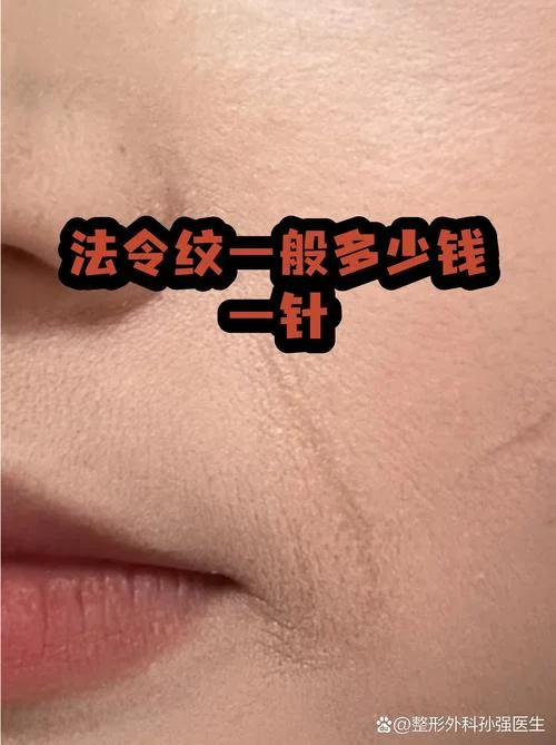 玻尿酸填充一针多少钱_1