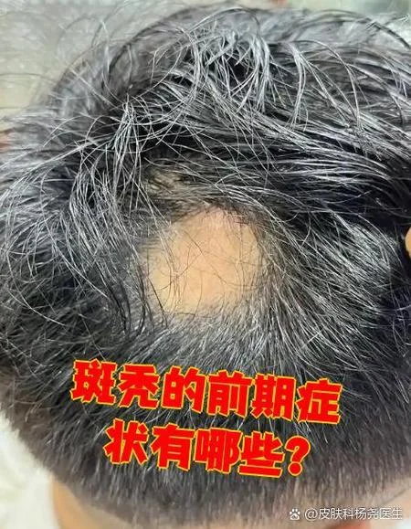 梦见儿子斑秃_1