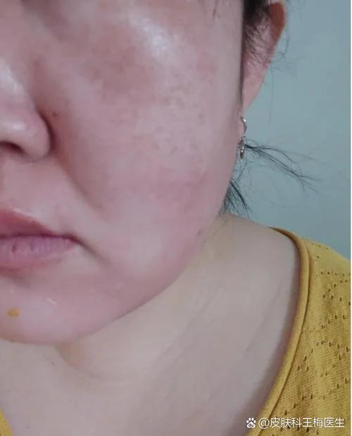 梦见自己的脸烂了过敏-梦脸烂过敏