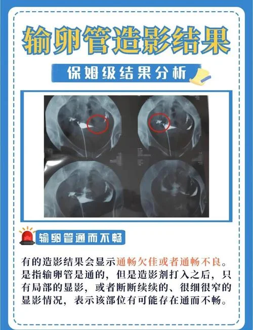 怎么样证明输卵管是通的-证明输卵管通畅