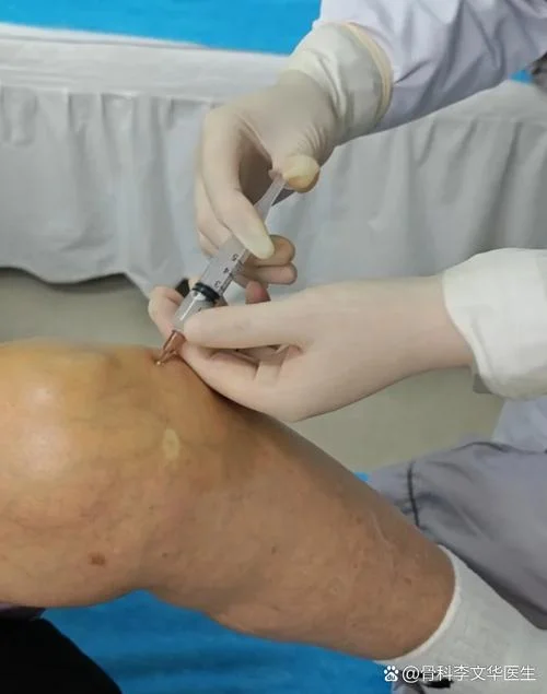 什么是prp治疗膝关节-什么是 prp 治膝