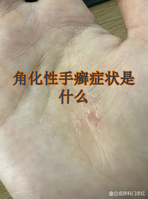 什么是鹅掌风图片_1