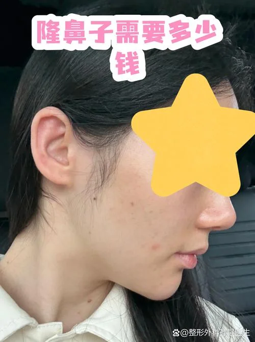 做硅胶隆鼻需要多少钱_1
