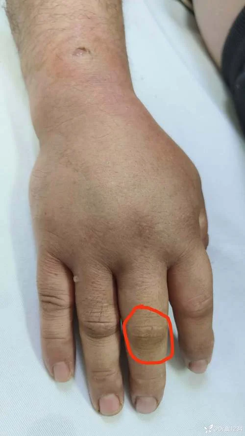 梦见被蛇咬手指头_1