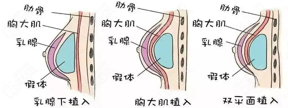 丰胸原理_2