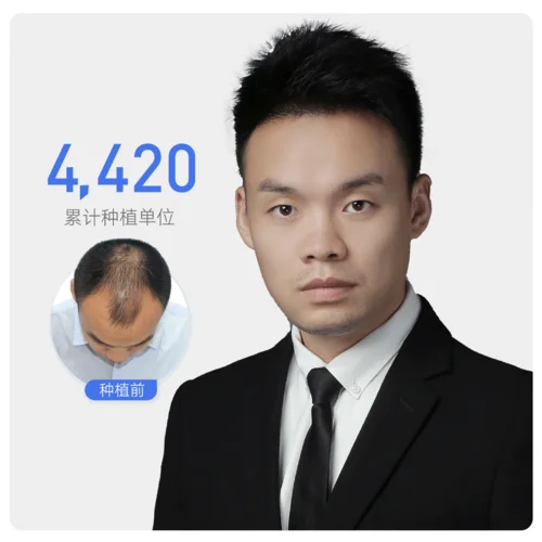 鬼剃头治疗多少钱_1