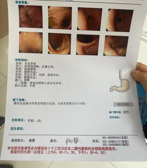 慢性胃炎报告怎么写-慢性胃炎报告撰写