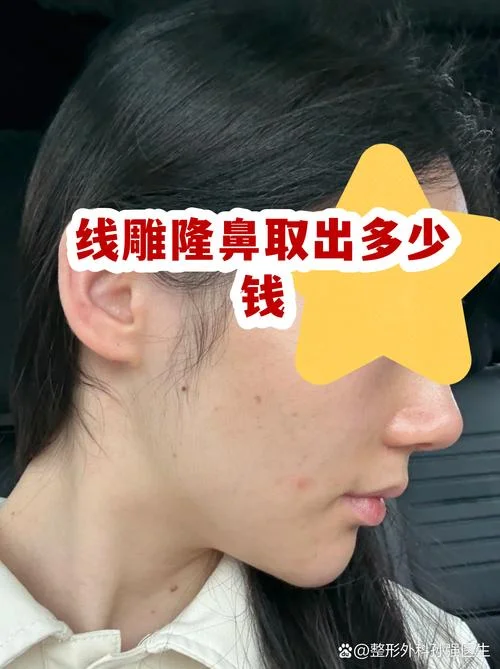 线雕隆鼻多少钱一根_1