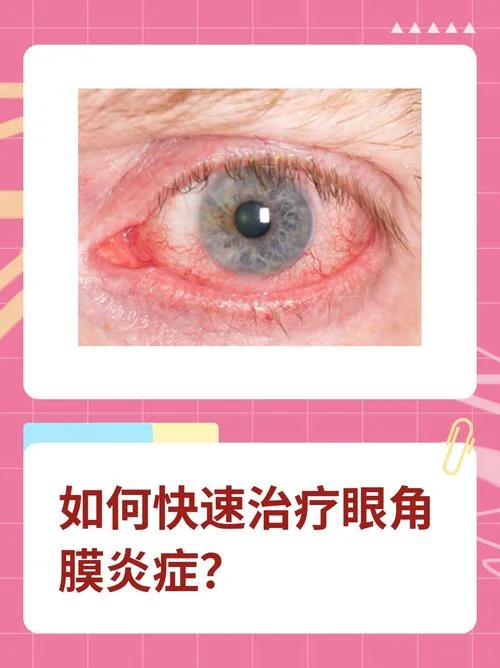 一个眼角膜多少钱-一个眼角膜价格