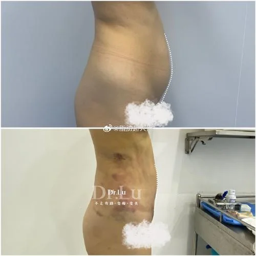 腰部吸脂一般多少钱_1