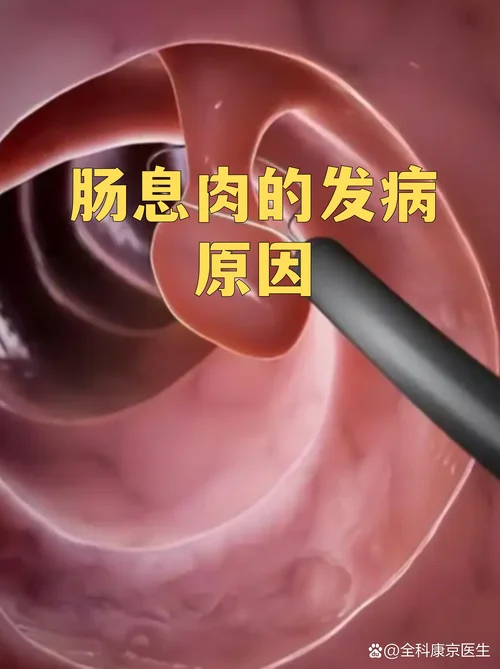 什么是直肠山田1型息肉_1
