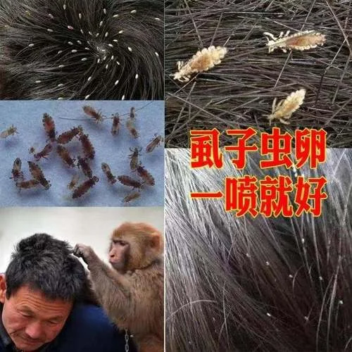 梦见亲人头上长虱子_2