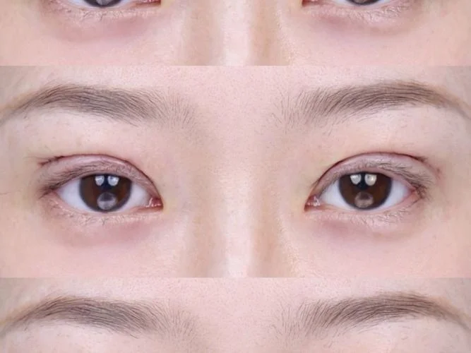 杭州双眼皮多少钱_1