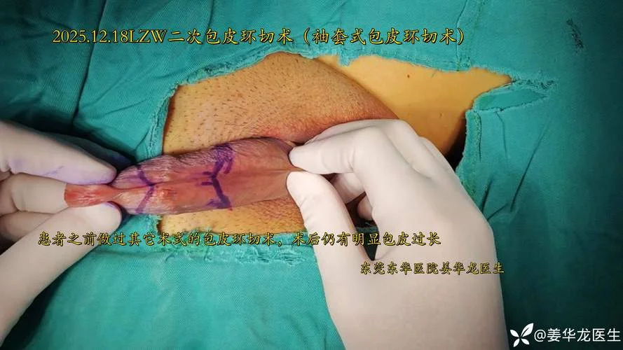 成人包茎修复术_1