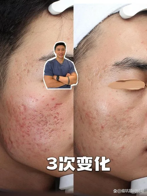 治疗痘坑要多少钱_2