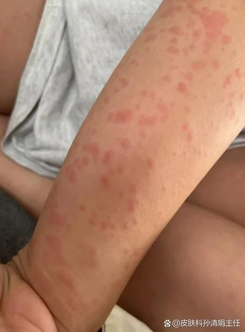 什么是热性荨麻疹-热性荨麻疹定义
