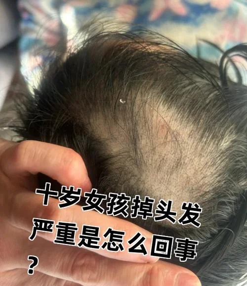 梦见儿子掉头发快秃了_1