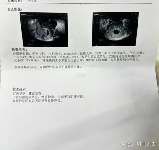 孕囊算孕周公式表_2