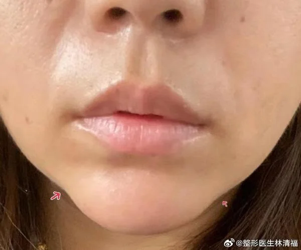梦见假体下巴歪了_2
