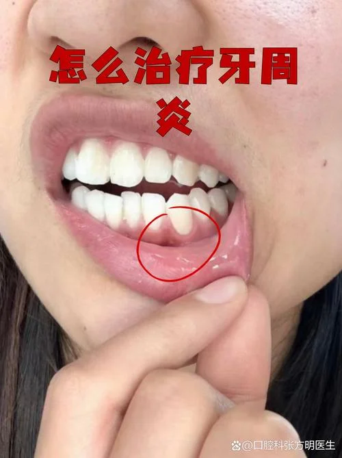 牙周炎治疗要花多少钱_1