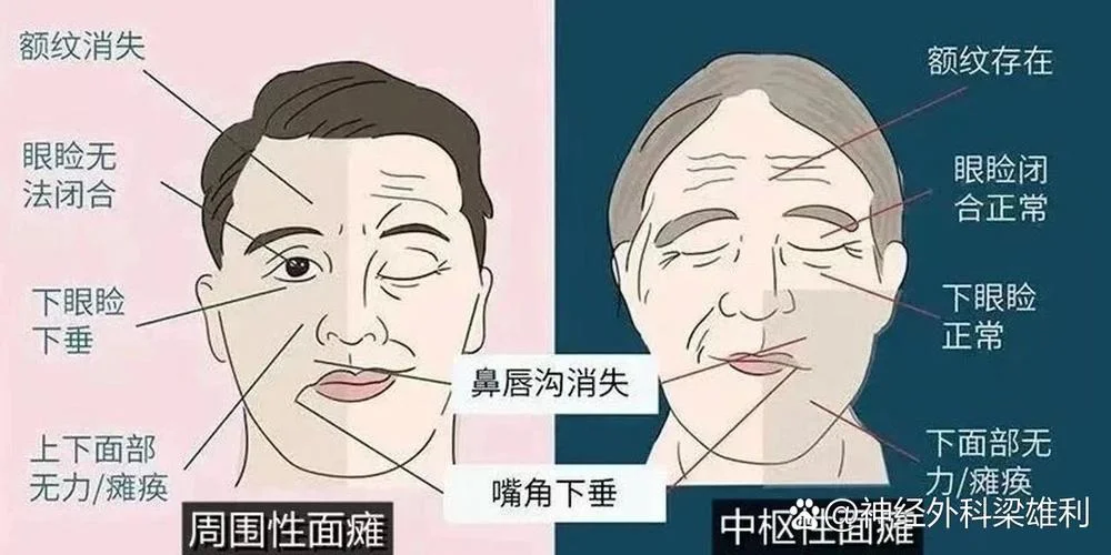梦见嘴歪_1