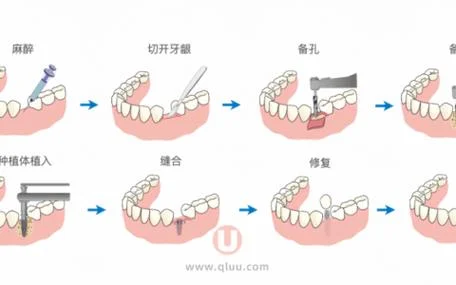 种牙的原理图_2