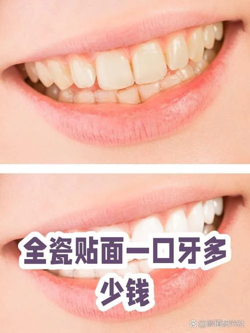 做了瓷贴面多少钱一颗_1