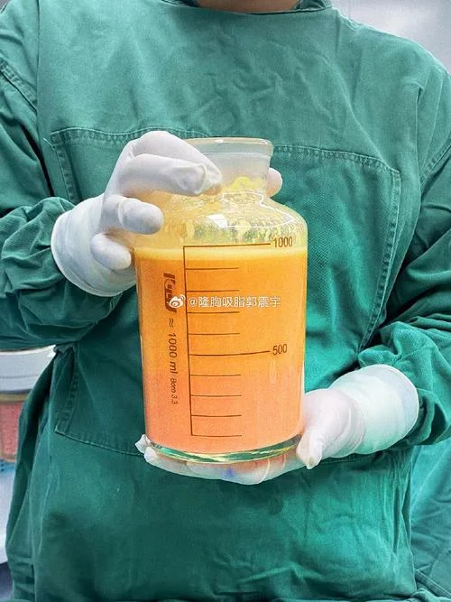 抽脂隆胸要多少钱_1