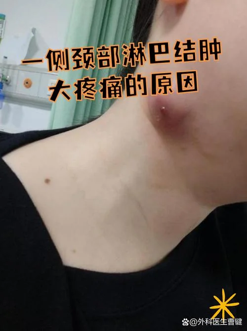 脖子里有淋巴结怎么办-淋巴结肿大需警惕