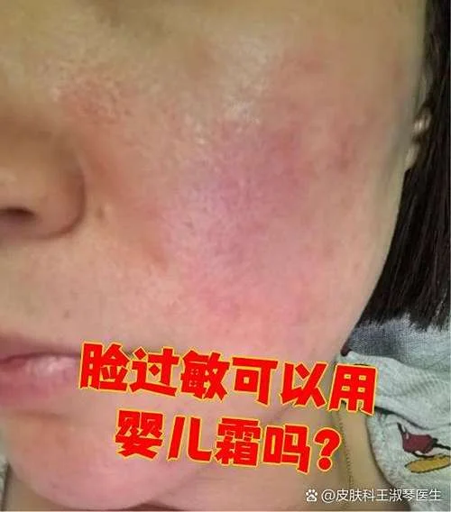 脸爱过敏是缺什么_1
