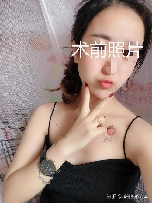 妙桃假体丰胸一次多少钱_1