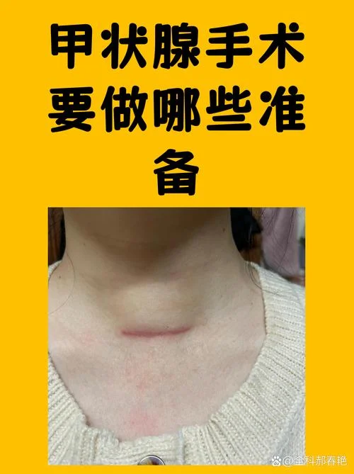 甲状腺囊肿手术需要多少钱_1